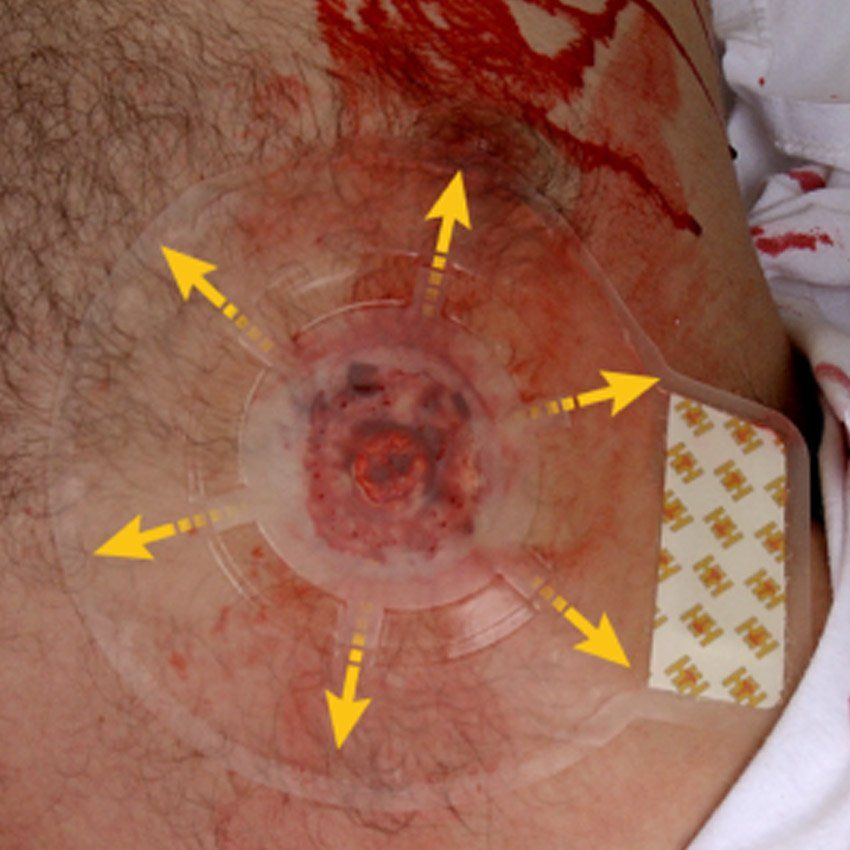 Halo Vent Chest Seal - 2 Pezzi